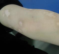 女性白癜风患者要怎样护理皮肤