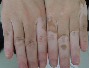 青少年患者怎样护理皮肤